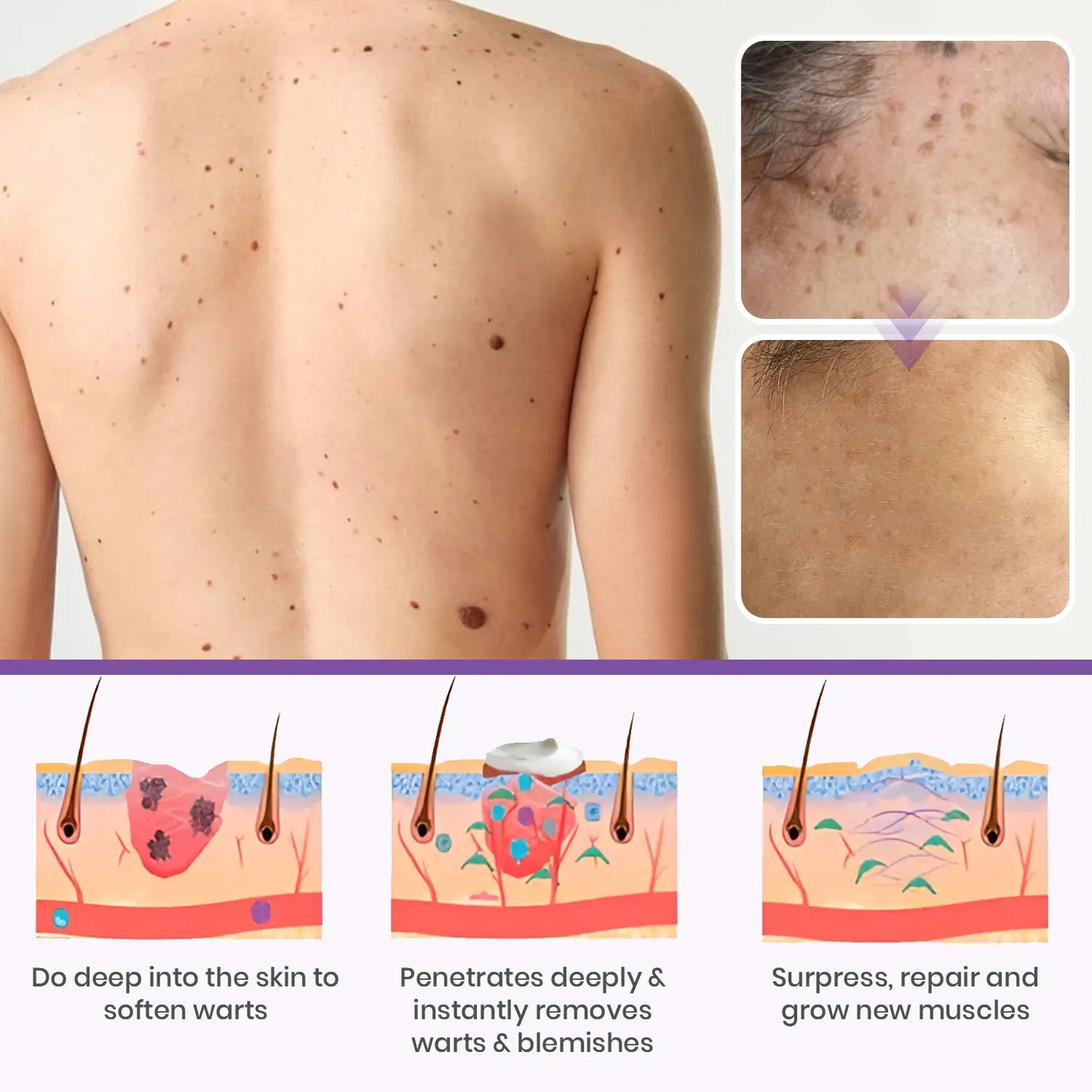 Jynxie® Clarivine Dissolver Mole & Dark Spot Removal Bio-Gel