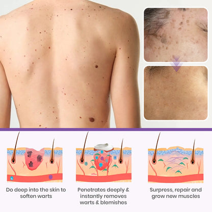 Jynxie® Clarivine Dissolver Mole & Dark Spot Removal Bio-Gel