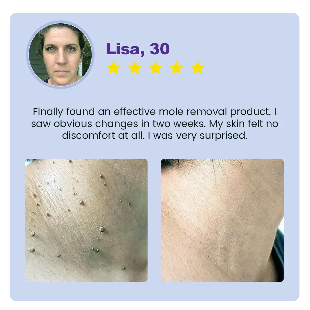Jynxie® Clarivine Dissolver Mole & Dark Spot Removal Bio-Gel