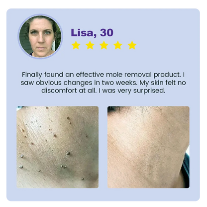Jynxie® Clarivine Dissolver Mole & Dark Spot Removal Bio-Gel
